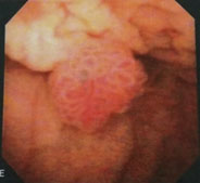膀胱腫瘍